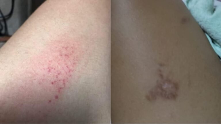 População reclama de coceira intensa em Itaituba