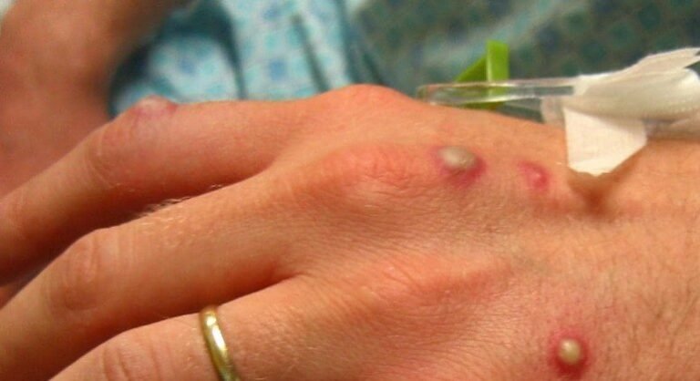 Anvisa sugere máscara e isolamento para adiar chegada de varíola do macaco ao Brasil