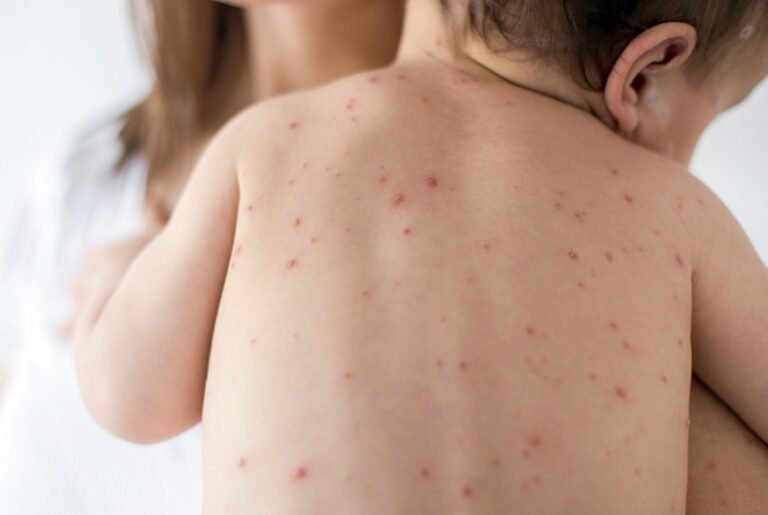 Secretaria Municipal de Saúde de Itaituba PA, alerta para baixa procura por vacinação contra o Sarampo no Município