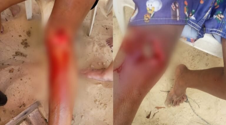 Duas pessoas são atacadas por piranhas na Praia do Aramanaí em Itaituba, no PA