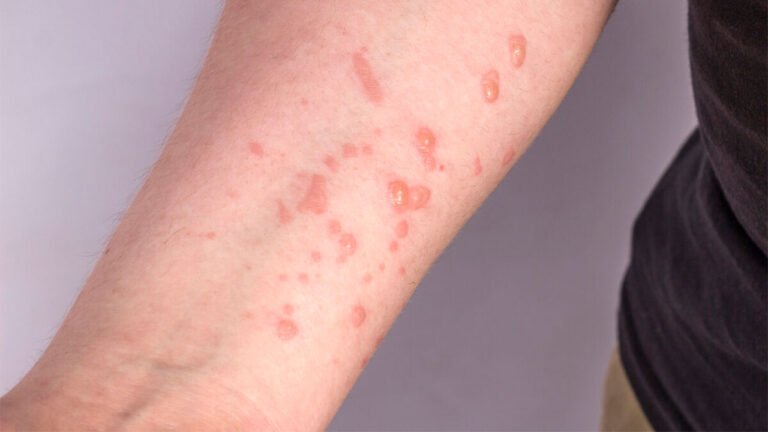 Varíola dos macacos: MPOX será o novo nome da doença