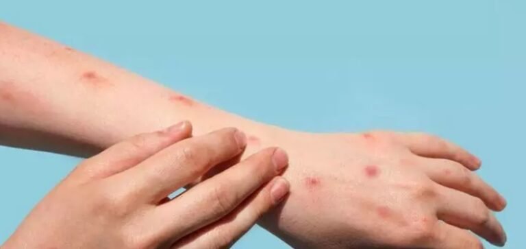 Pará tem 96 casos confirmados da Mpox, aponta Sespa