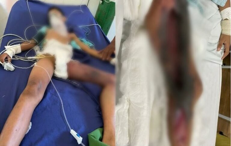 Menino de 11 anos é picado por cobra no interior de Itaituba e corre risco de perder a perna; família pede ajuda
