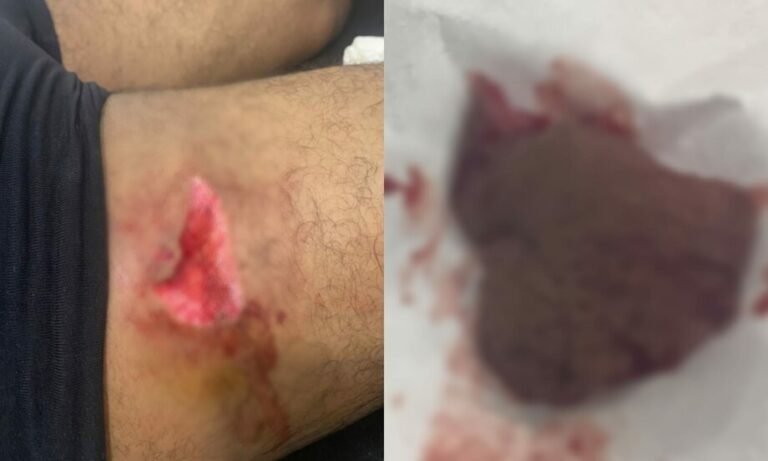 Homem é atacado por piranhas e leva mordida profunda na perna, em Itaituba