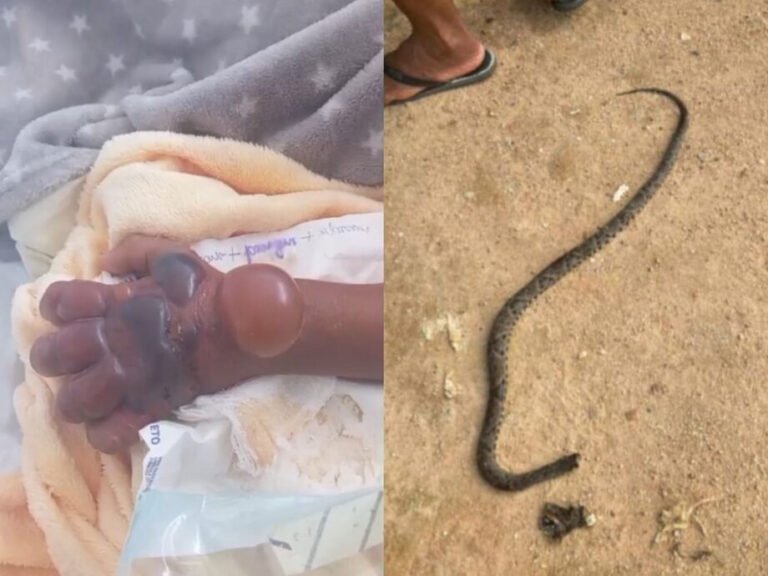 VÍDEO; Criança de 5 anos é picada por jararaca em área de garimpo em Novo Progresso